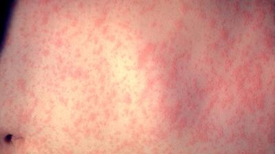 Bangladesh measles outbreak kills over 500 children