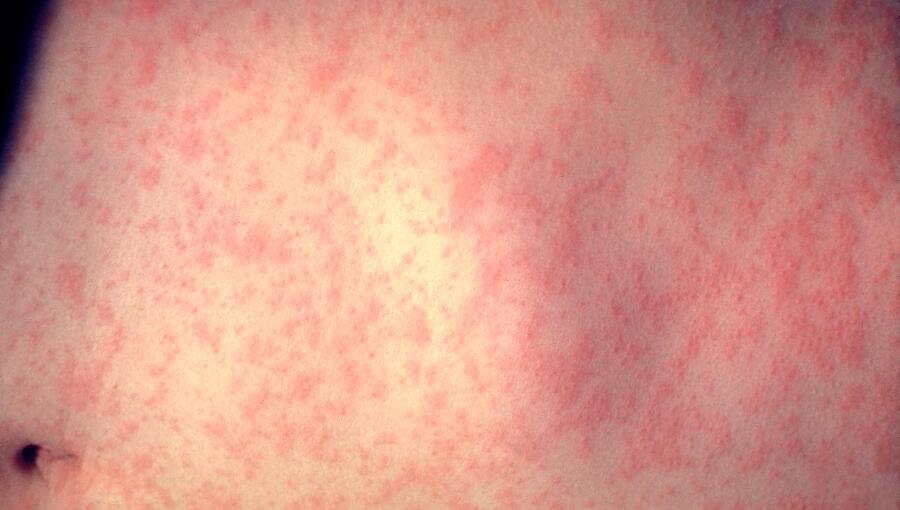 Bangladesh measles outbreak kills over 500 children